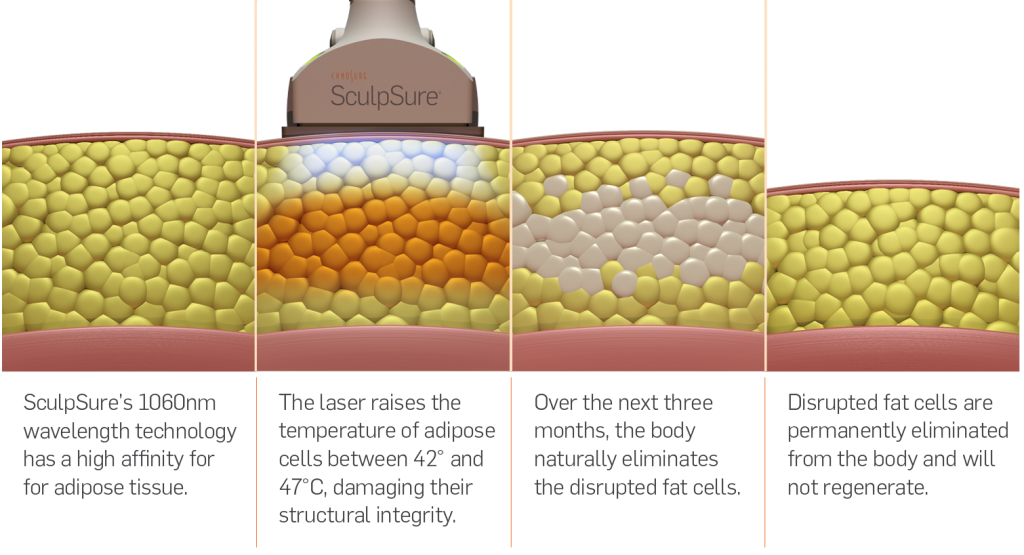 How SculpSure works